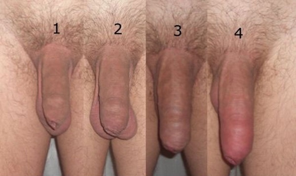 Transmen clitoris size without sugery